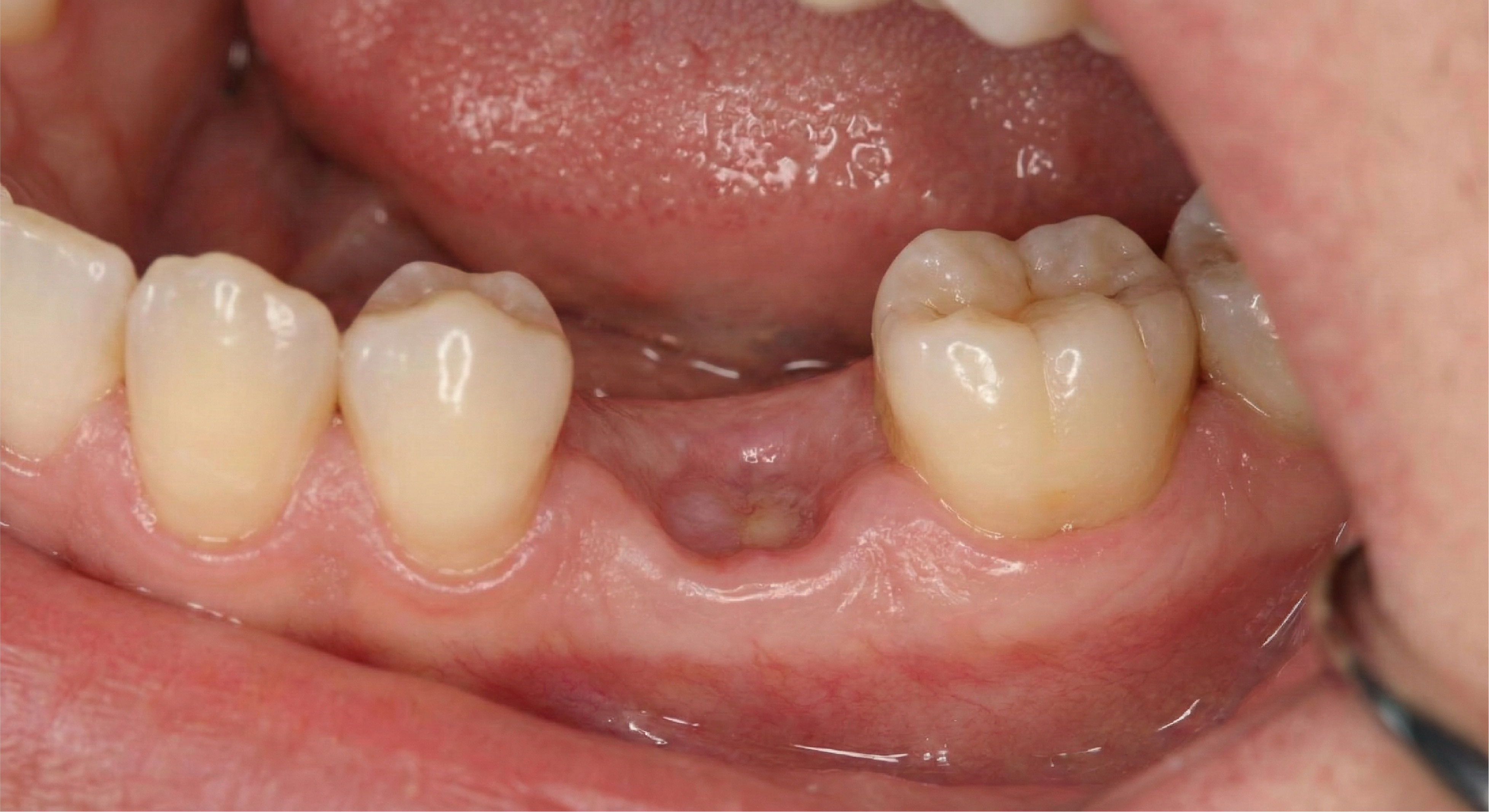 Before — PFM Bridge